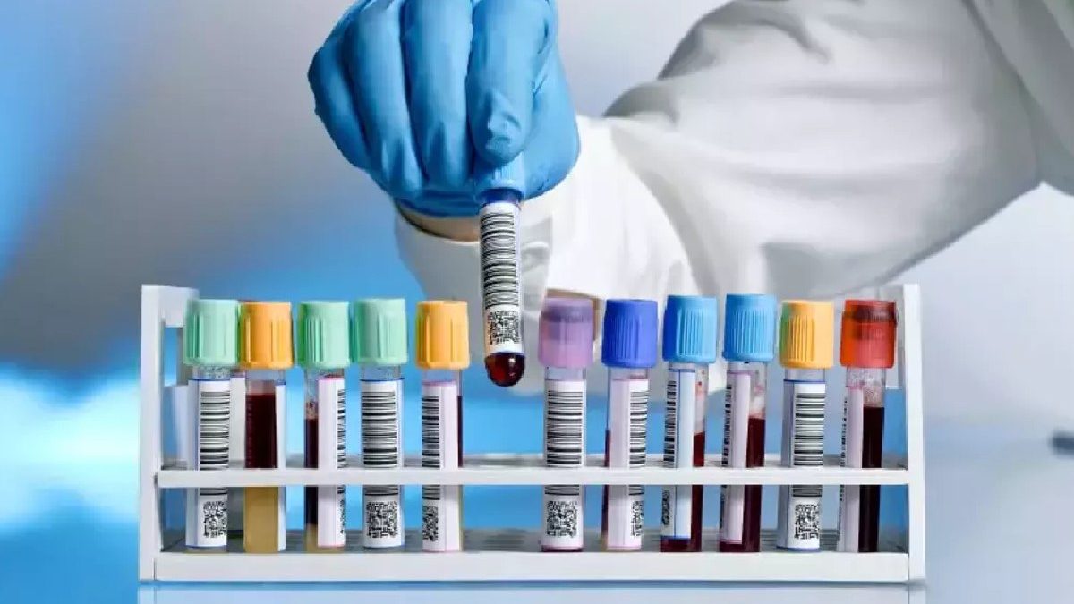 Anti Hbs (Mikropartikül Immün Assay-Meia Veya Benzeri)