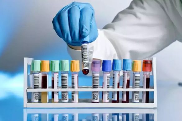 Anti Hbs (Mikropartikül Immün Assay-Meia Veya Benzeri)